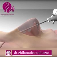 رفع پولیپ بینی با جراحی
