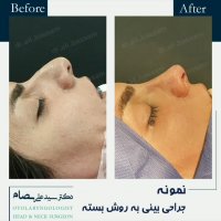 فیلم عمل بینی بسته توسط دکتر سید علی بصام