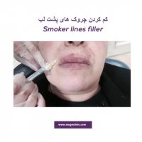 درمان چروک دور چشم