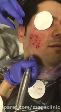 میکرونیدلینگ برای اسکارهایی با عمق زیاد