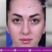 عمل تیپ پلاستی | جراح بینی | دکتر لاجوردی