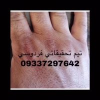 اگزما درمان شد ببینید