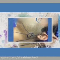 جراحی تومور غده بناگوشی