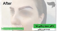 بهترین روش کاشت ابرو کدام است؟