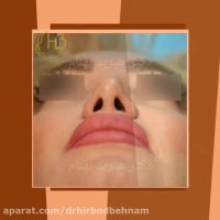 نمونه جراحی ترمیم بینی دکتر هیربد بهنام