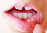 درمان آفت کودکان