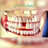 ایمپلنت دندان