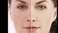 درمان جوش صورت