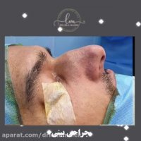 بلافاصله بعد از جراحی بینی