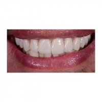 اصلاح طرح لبخند