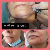 فیلم تزریق ژل خط اندوه