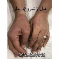 اگزما پوستی چیست ودرمانی دارد ؟