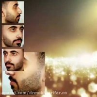 سه هفته بعد از جراحی بینی