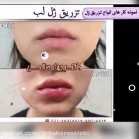 نمونه کار تزریق ژل