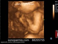 بازوی جنین به صورت سه بعدی