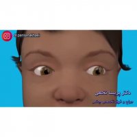 انیمیشن درمان انحراف چشم