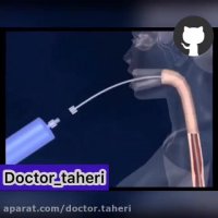 نحوه ى گذاشتن بالون معده جهت لاغرى