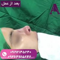 فیلم قبل و بعد از عمل بینی