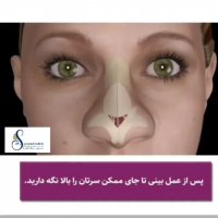 مراقبت های بعد از جراحی بینی