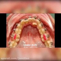 مراحل درمان ارتودنسی / متخصص ارتودنسی / دکتر جمیلیان