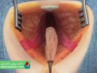 تشخیص علایم و نشانه های فیستول مقعدی (آبسه) توسط دکتر بیژن عابدیان