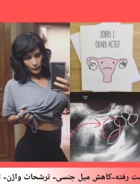 درمان قطعی بیماری کیست تخمدان و نازایی در یک ویدئو