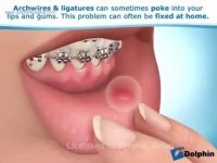 نحوه مدیریت ناراحتی های حین ارتودنسی