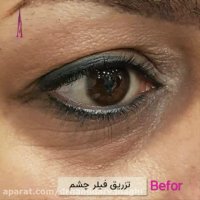 فیلم قبل و بعد تزریق فیلر زیر چشم