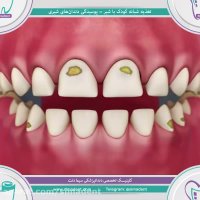 پوسیدگی دندان شیری با تغذیه شبانه  | دندانپزشکی سیمادنت