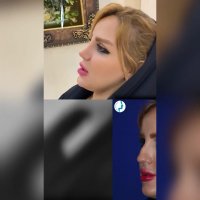 رضایت بیمار بیست و پنج روز بعد از جراحی بینی