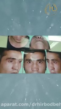 نمونه جراحی بینی مردانه دکتر هیربد بهنام