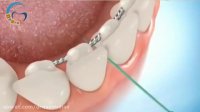 ریتینر ثابت و بهداشت ارتودنسی | دکتر مسعود داوودیان
