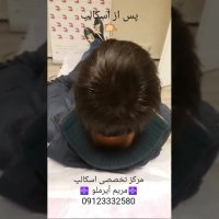 اسکالپ بهترین روش برای رفع کم پشتی موی خانمها