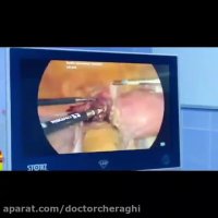 فیلم واقعی جراحی تومور رحم