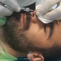 بینی خوش فرم با تزریق فیلر