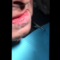 Abcess drainage and extraction - Dr Matt Tocuseanu @ Simi Dental Care