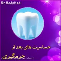 حساسیت های بعد از جرمگیری دندان