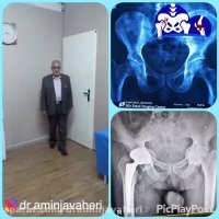 معاینه بیمار بعد از جراحی تعویض مفصل لگن