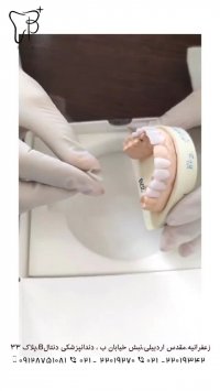 تعویض کامپوزیت های قدیمی با لمینت