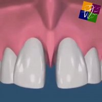 بستن فضای بین دندانی به کمک یک جراحی کوچک