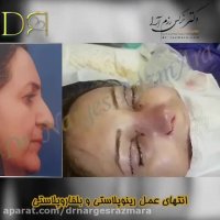 عمل رینوپلاستی و بلفاروپلاستی