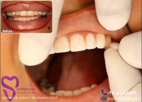 امتحان نهایی تحویل لمینت سرامیکی