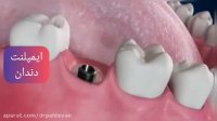 ایمپلنت دندان جلو