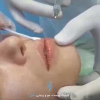 هزینه برجسته سازی لب‌ها با تزریق ژل