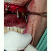 ایمپلنت فول فک بالا