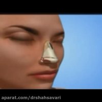 جراحی انحراف بینی
