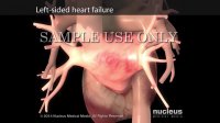 Effects of Congestive Heart Failure