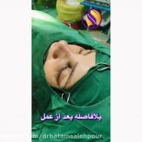 بلا فاصله بعد از اتمام عمل بینی