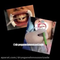 کامپوزیت دندان