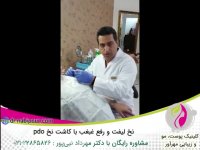 نخ لیفت و رفع غبغب با کاشت نخ pdo
